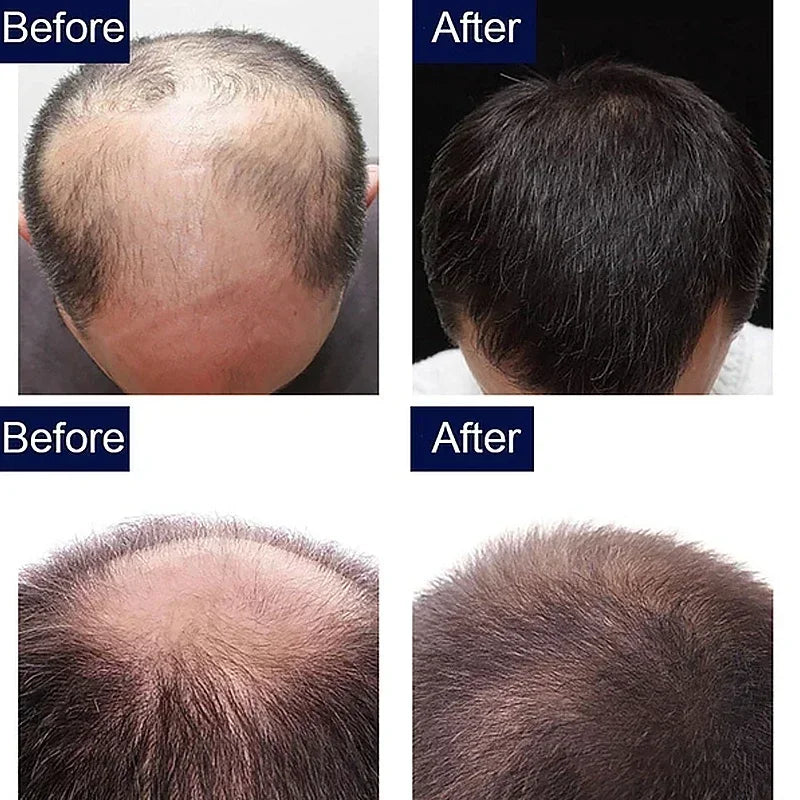 Ginger Growth Hair Treatment Anti Hair Loss Men Women Scalp Treatment Serum